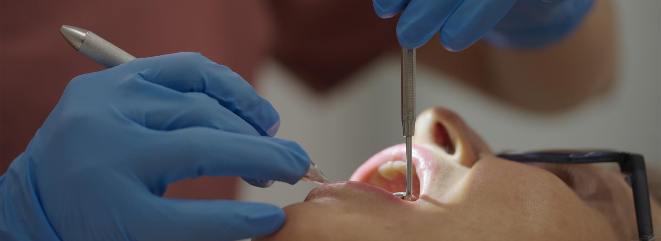 persons mouth with dental tools